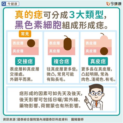 痣的形成原因|痣是什麼？一次了解痣原因、就醫時機以及如何改善